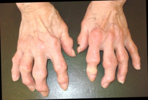 Artiregen 6x Arthrose médicament