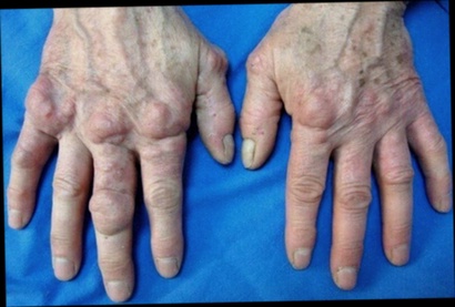Cartiregen Arthrose naturel pas cher