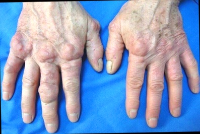 Anti-inflammatoire Arthrose Coenzyme Q10