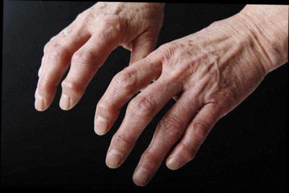 Remède de grand-mère arthrose des doigts