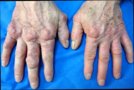 Remède Douleur Hanche
